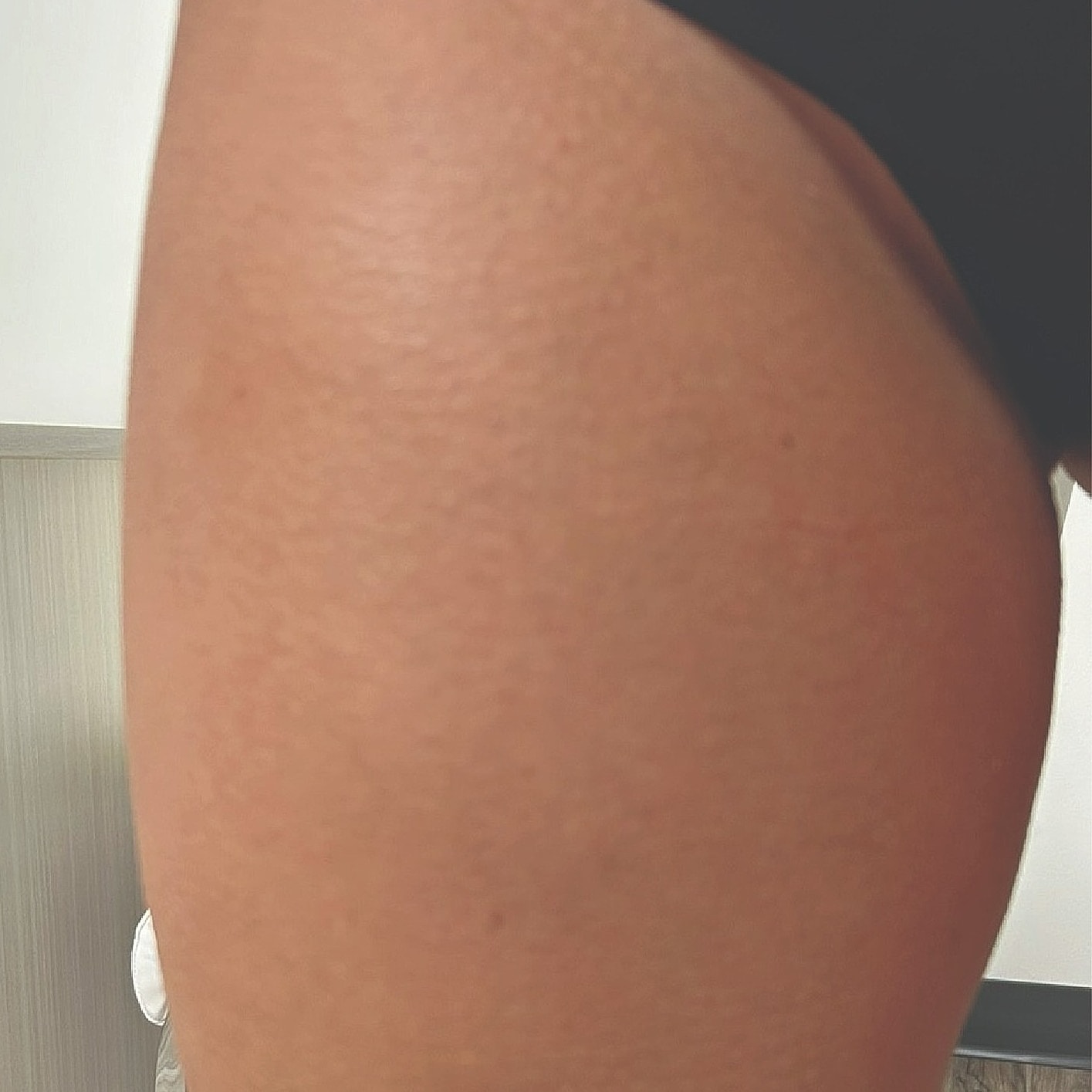 Close-up of a thigh against a neutral background.